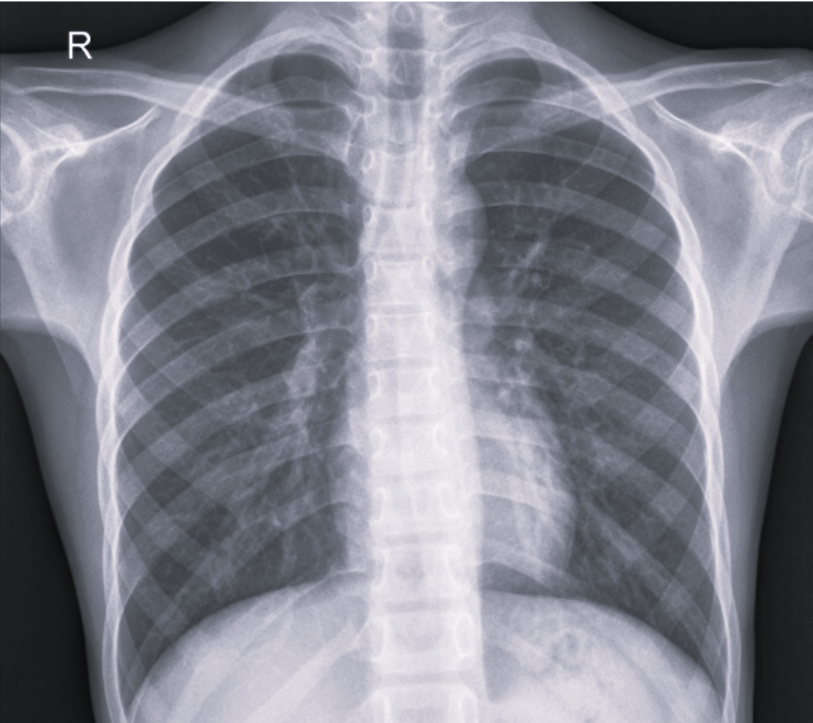 image of chest xray